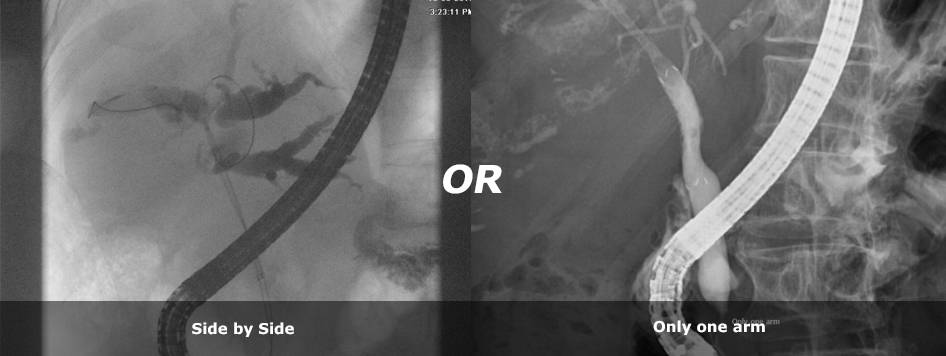 Side by Side or Only one arm
